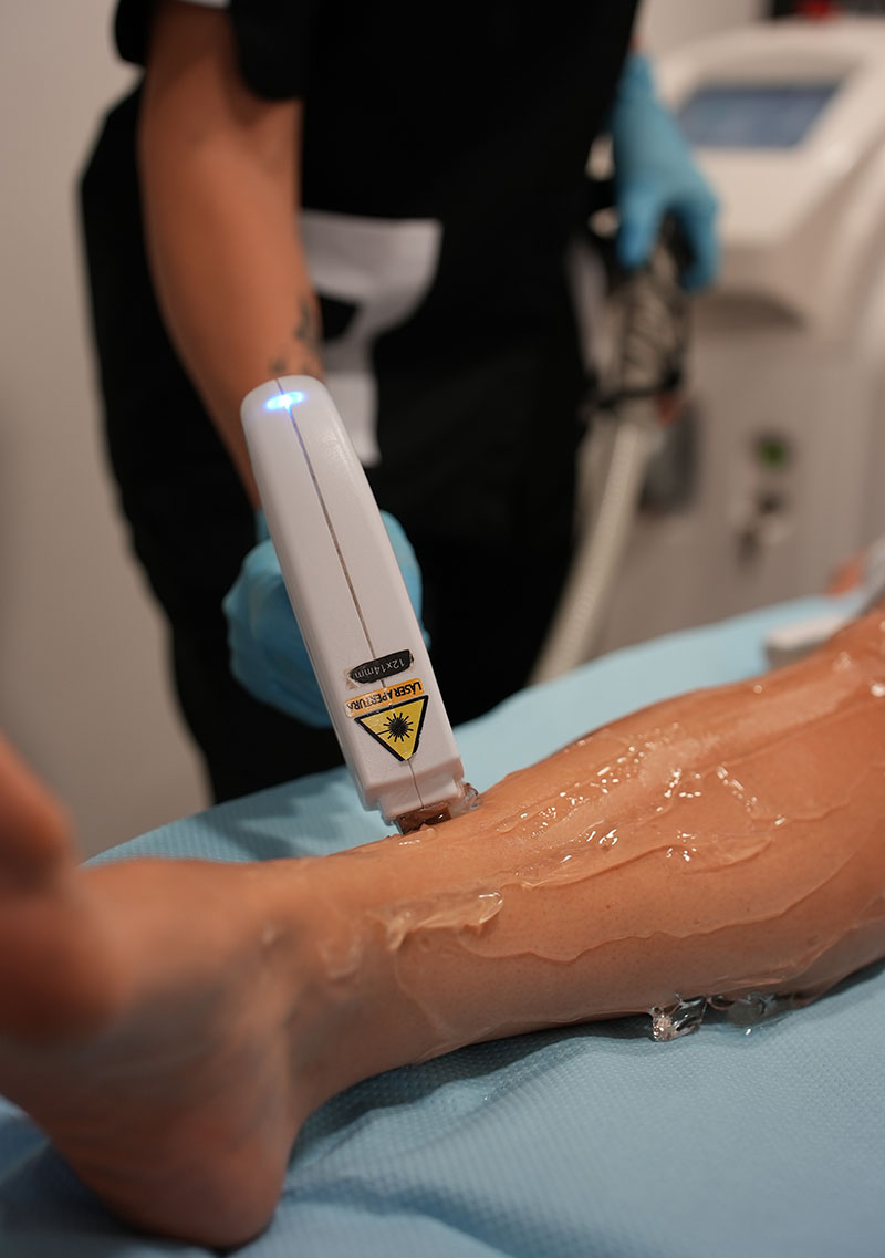 depilacion-laser
